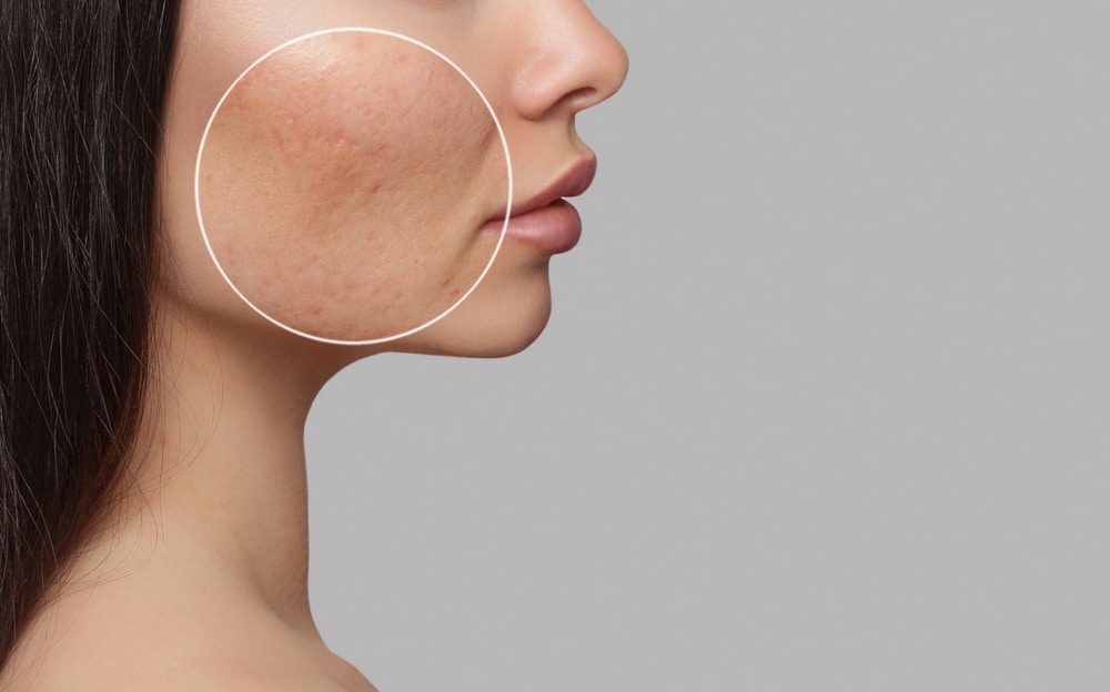 Close up of a patient's cheek with acne scarring, in need of CO2 Skin Resurfacing.