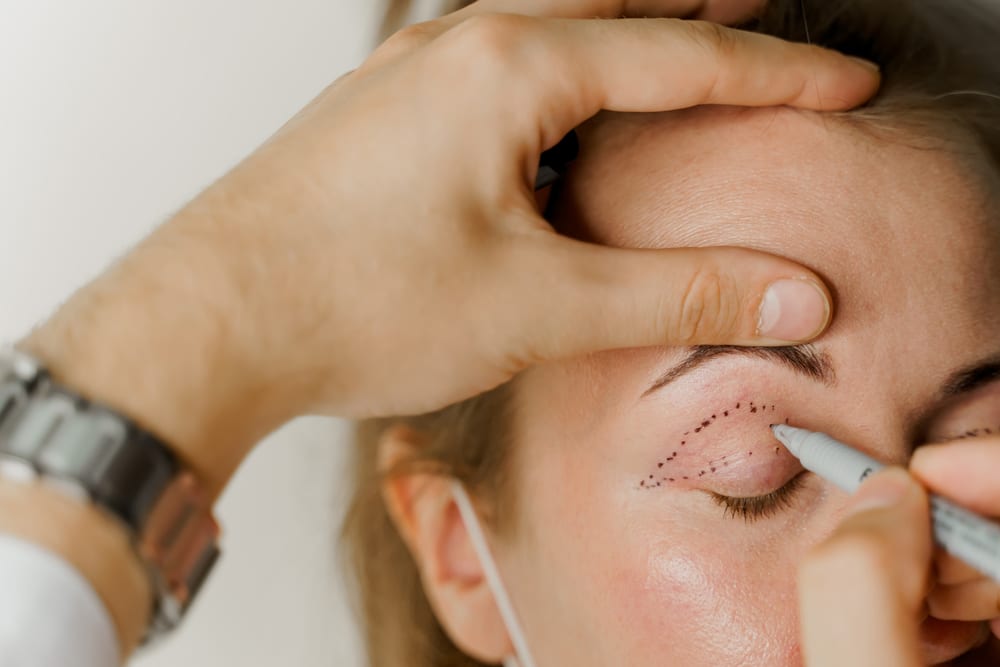 Woman having her upper eyelids drawn on by her plastic surgeon in preparation for her blepharoplasty. Woman having her upper eyelids drawn on by her plastic surgeon in preparation for her blepharoplasty.