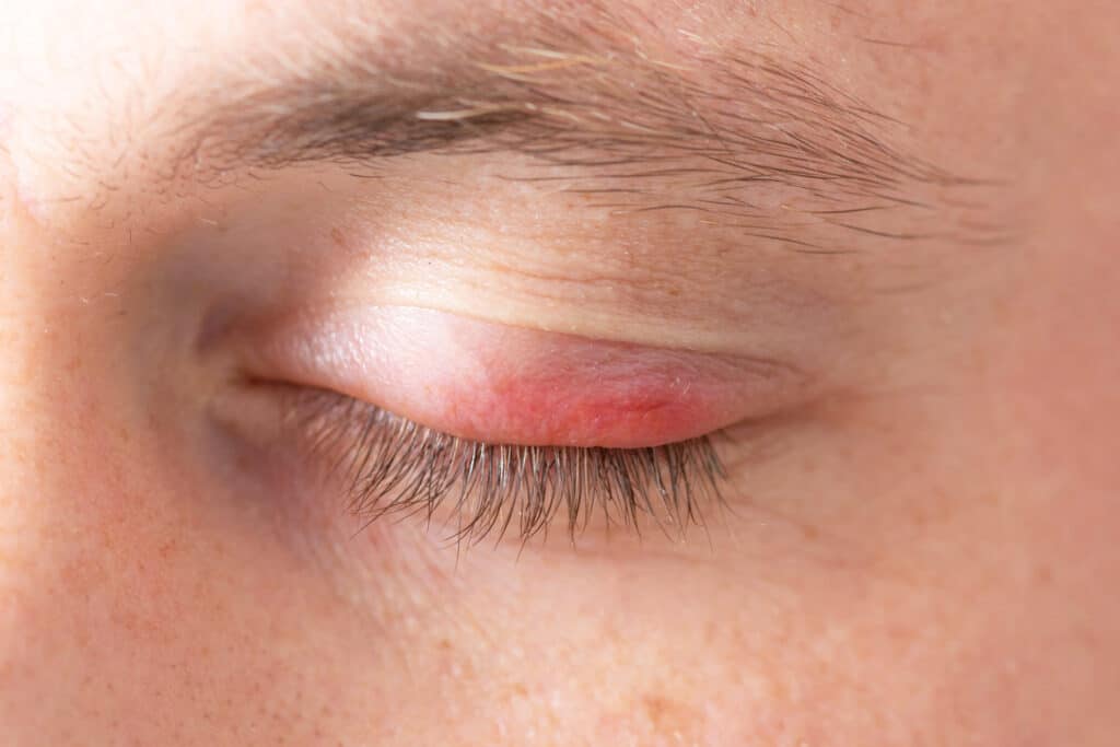 Swelling of the eye. Swollen upper lid. Close up. Close-up of a patient with their eye closed, a bright red spot on their eyelid in pain.